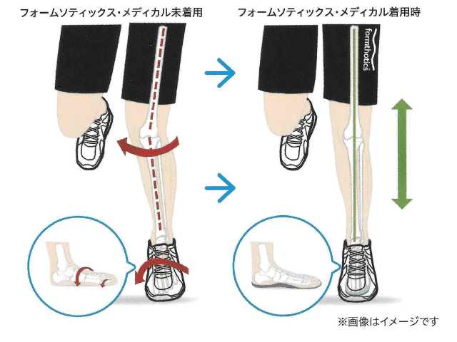 足の痛みの原因は足首の歪み