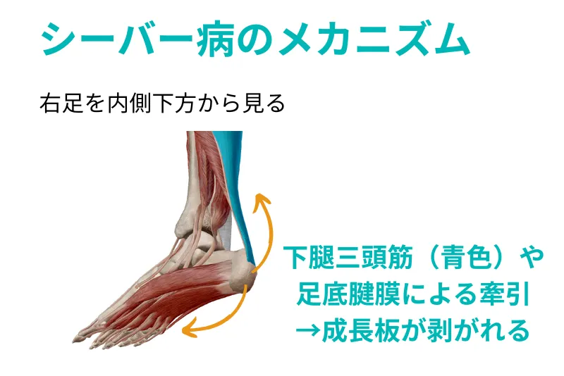 シーバー病のメカニズム