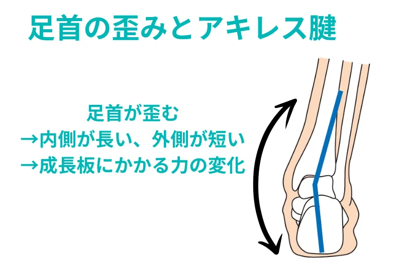 足首の歪みとアキレス腱