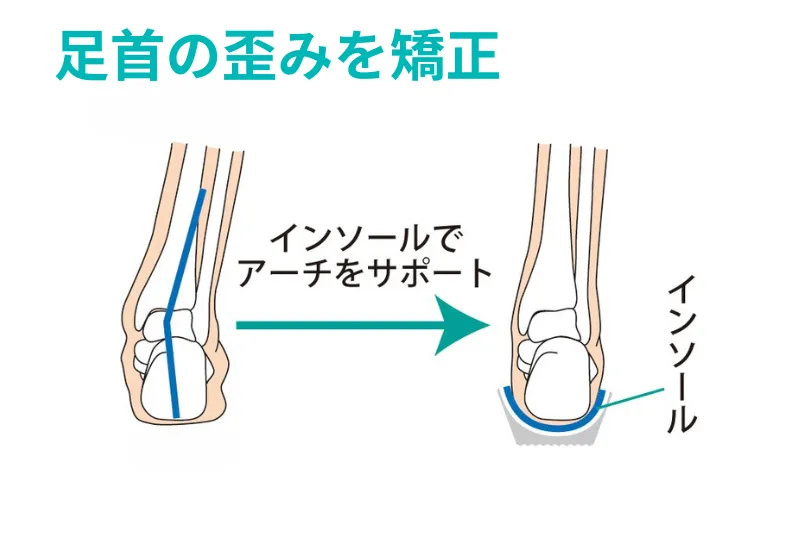 インソールで足首の歪みを矯正
