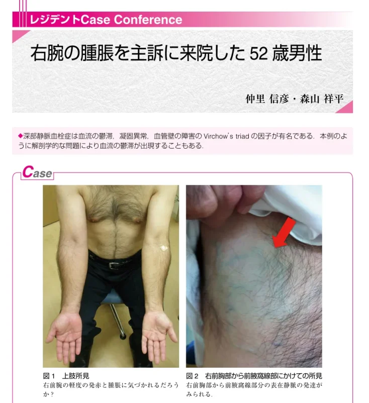 深部静脈血栓症