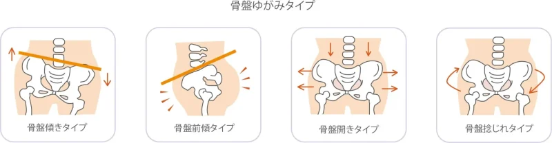 骨盤の歪み方