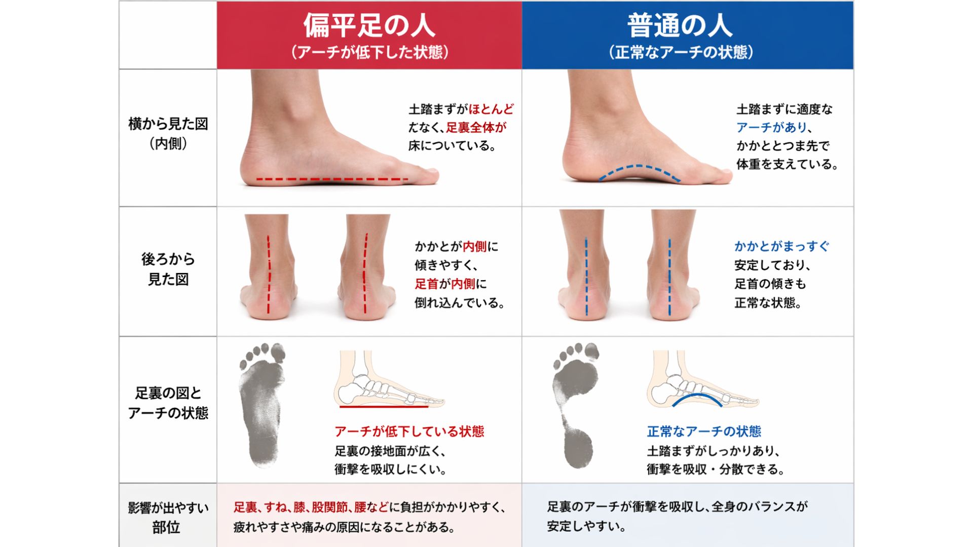 偏平足・状態